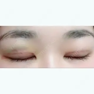 5日目の経過画像（2枚目）
