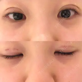 0日目の経過画像（1枚目）
