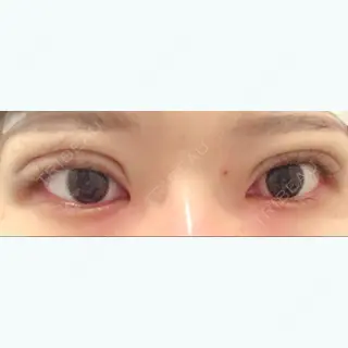 0日目の経過画像（1枚目）