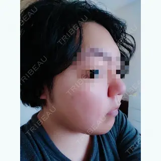 7日目の経過画像（2枚目）
