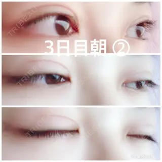3日目の経過画像（2枚目）