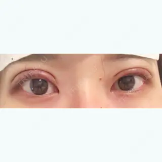 0日目の経過画像（1枚目）