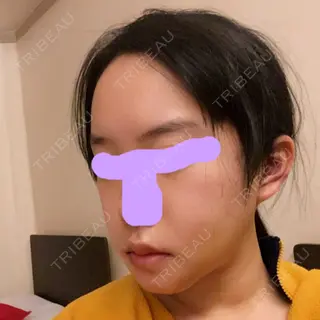 4日目の経過画像（2枚目）