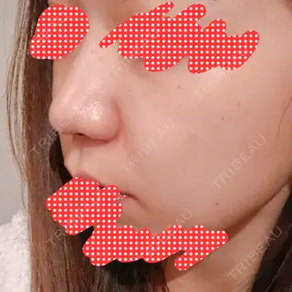0日目の経過画像（1枚目）