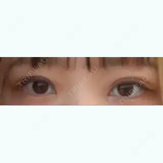 11日目の経過画像（1枚目）