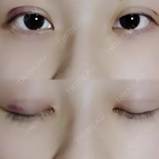 6日目の経過画像（1枚目）