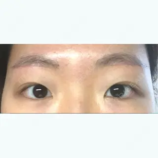 30日目の経過画像（1枚目）