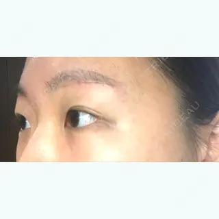 30日目の経過画像（2枚目）