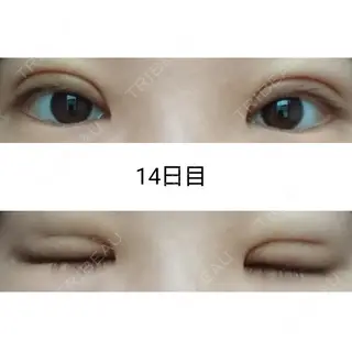 14日目の経過画像（1枚目）