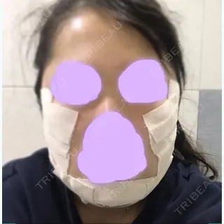 2日目の経過画像（1枚目）