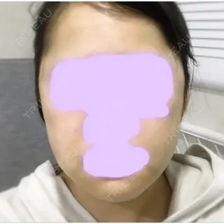 3日目の経過画像（1枚目）