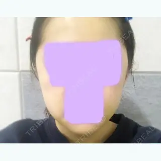 6日目の経過画像（1枚目）