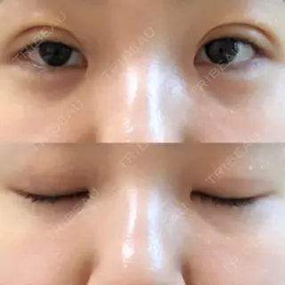 2日目の経過画像（1枚目）
