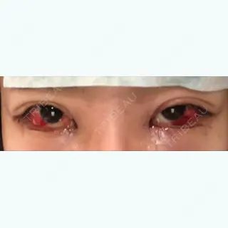 0日目の経過画像（1枚目）