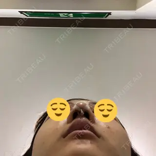 2日目の経過画像（3枚目）