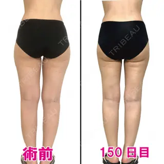 151日目の経過画像（3枚目）