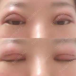 1日目の経過画像（1枚目）