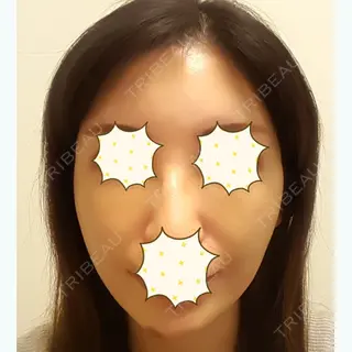 5日目の経過画像（1枚目）