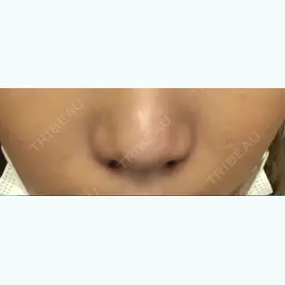 2日目の経過画像（1枚目）