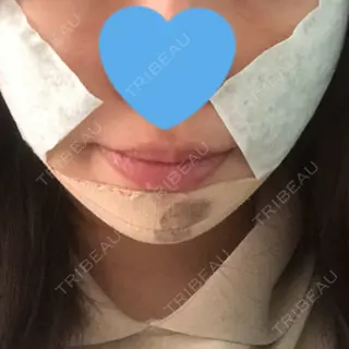 0日目の経過画像（1枚目）