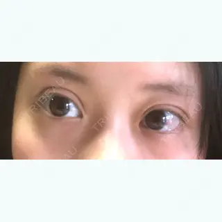 3日目の経過画像（1枚目）