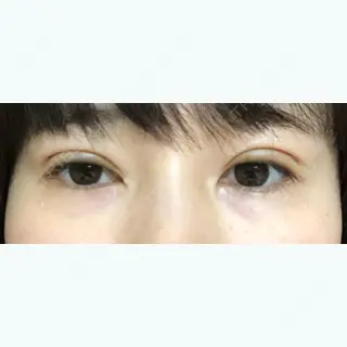 6日目の経過画像（1枚目）