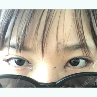 0日目の経過画像（1枚目）