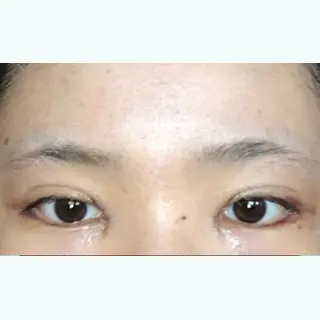 1日目の経過画像（1枚目）