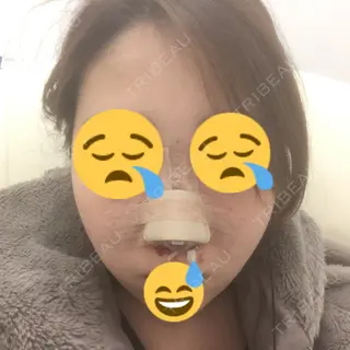 0日目の経過画像（1枚目）