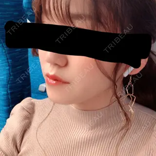 74日目の経過画像（2枚目）