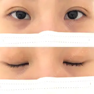 3日目の経過画像（1枚目）