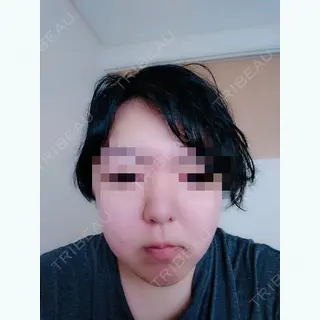 8日目の経過画像（1枚目）