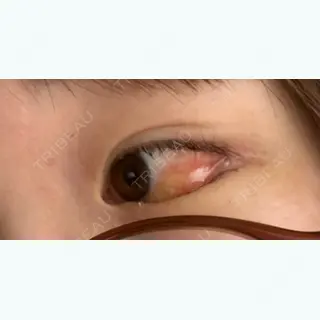 5日目の経過画像（3枚目）