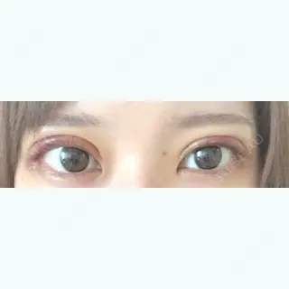 4日目の経過画像（1枚目）
