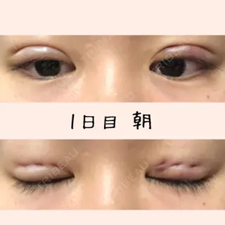 3日目の経過画像（1枚目）