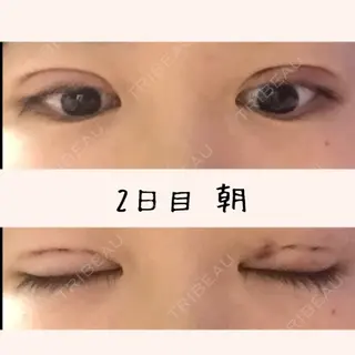 3日目の経過画像（1枚目）