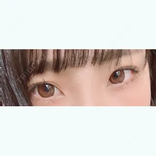 66日目の経過画像（1枚目）