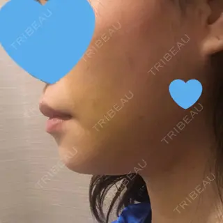 7日目の経過画像（2枚目）