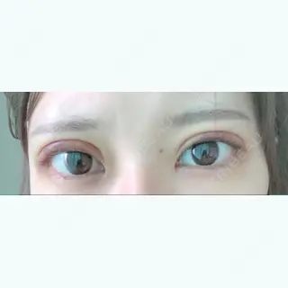 5日目の経過画像（1枚目）
