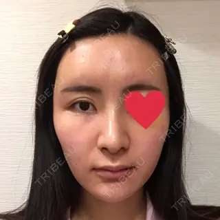 9日目の経過画像（1枚目）