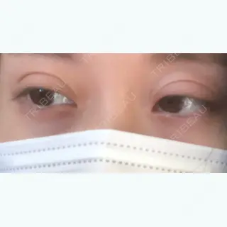 5日目の経過画像（2枚目）
