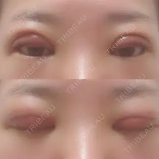 2日目の経過画像（1枚目）