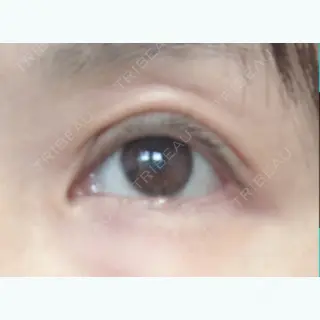77日目の経過画像（1枚目）