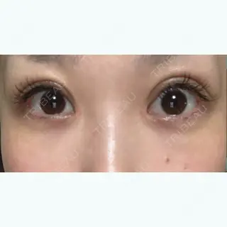 70日目の経過画像（1枚目）