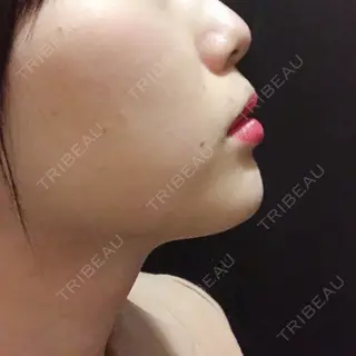 1日目の経過画像（2枚目）