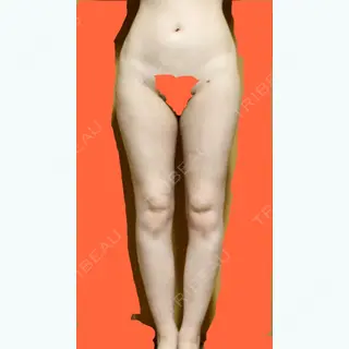 42日目の経過画像（1枚目）