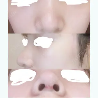 8日目の経過画像（1枚目）