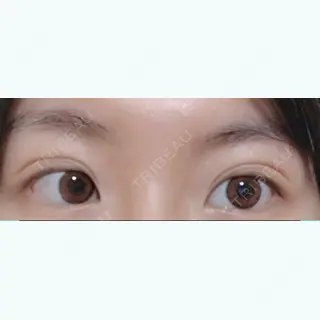 16日目の経過画像（1枚目）
