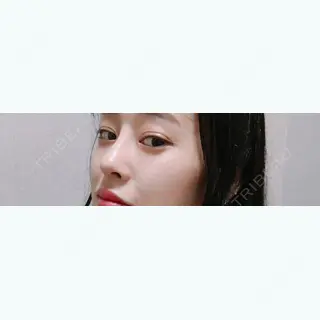 21日目の経過画像（2枚目）