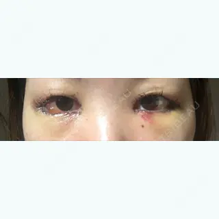 3日目の経過画像（1枚目）